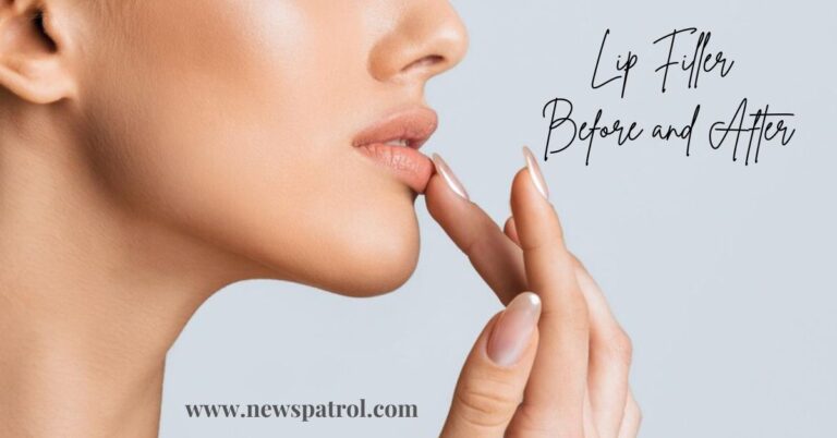 Transform Your Smile: Stunning Lip Filler Before and After Transformations